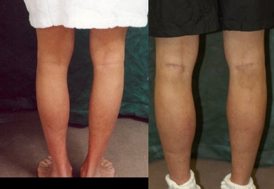Men's Calf Augmentation   - 
	Men&#39;s Calf Augmentation W/Implants
