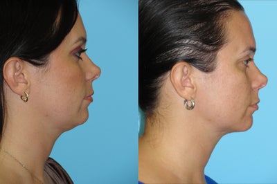 Neck Liposuction - 
	This patient continued to have excess fullness under her chin despite eating well and working out. Performed an in office neck liposuctioning procedure to remove the excess fat.
