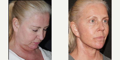 55-64 year old woman treated with Facelift, Neck Lift, Facelift Revision - 55-64 year old woman undergoes facelift, neck lift surgery by Dr Bashar Bizrah
