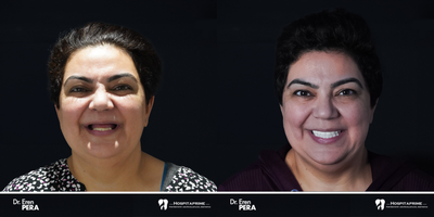 45-54 year old woman treated with Dental Implants - hospitaprime