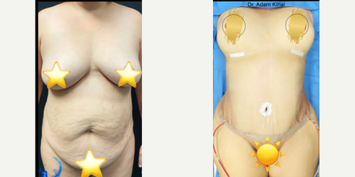 35-44 year old woman treated with Diastasis Recti Repair, Breast Reconstruction, Smart Lipo - The patient presented for a diastasis recti repair with a tummy tuck, breast augmentation, and liposuction (lipo360).