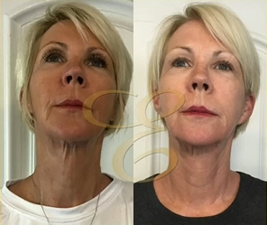 Woman treated with Skin Tightening - Woman treated with Skin Tightening