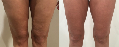 45-54 year old woman treated with Carboxytherapy - Carboxy therapy once weekly for 10 weeks to rejuvenate the skin on the front of the legs.