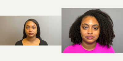 35-44 year old woman treated with Restylane, Dermal Fillers - Nasolabial folds