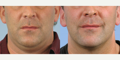 45-54 year old man treated with Thermage - Patient suffered from Thick Neck & Extreme Laxity
