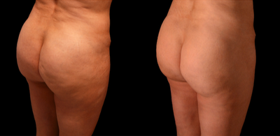 35-44 year old woman treated with Cellfina - Patient was concerned with dimples from Cellulite on buttock. Treated with Cellfina