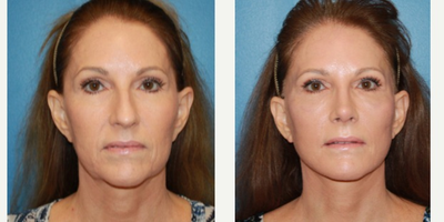 55-64 year old woman treated with Rhinoplasty - 59-year-old female treated with rhinoplasty and facelift