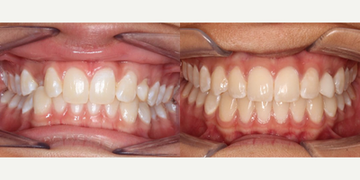 Woman treated with Braces - Woman treated with Braces.