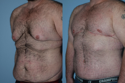 25-34 year old man treated with Male Tummy Tuck - Male tummy tuck and male breast reduction, 2 months postoperative.
