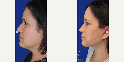 Woman treated with Mini Facelift, Rhinoplasty - Loving these results just 6 weeks after a mini face lift and open #rhinoplasty.She looks rejuvenated and refreshed following surgery. The nose has been contoured & refined giving her a natural look that fits her perfectly.