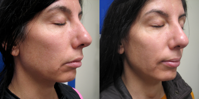 35-44 year old woman treated with IPL - Before and after 4 IPL treatments for color enhancement, redness and mild sun damage.