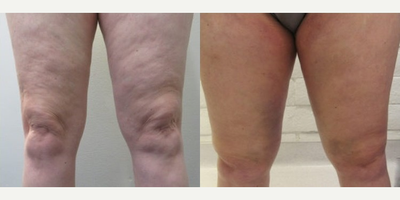 Woman treated with BodyTite - Woman treated with BodyTite
