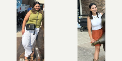 Woman treated with Gastric Sleeve Surgery - Bariatric Surgery