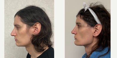 25-34 year old woman treated with Adam's Apple Reduction, Rhinoplasty, Forehead Reduction, Brow Bone Reduction, Genioplasty, Fac - this is a young lady who had forehead feminization, septorhinoplasty, and chin feminization.
