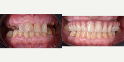 45-54 year old man treated with All-on-4 Dental Implants, Dental Implants, Full Mouth Reconstruction - This patient came to our office from USA was looking to regain his confidence and security, many dentists in the United States did not want to treat him and the costs were very high and did not give him options, we were able to place 4 dental implants and a reinforced acrylic prosthesis for greater durability and aesthetics.