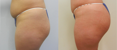 Woman treated with Brazilian Butt Lift - Woman treated with Brazilian Butt Lift