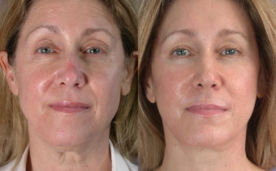 45-54 year old woman treated with Neck Lift - This 47-year-old woman desired facial rejuvenation. She decided to have a minimal incision facelift and necklift, upper and lower eyelid surgery, endoscopic browlift, CO2 laser resurfacing around the eyes and mouth, and upper and lower lip augmentation with alloderm.