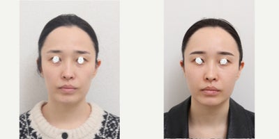 35-44 year old woman treated with Nonsurgical Facelift - Chief Complain: flat apple cheeks & foreahead, hollowed side cheeks & temples, nasolabial folds, uneven under eye areaTreatment Plan: non -surgical face lift by facial fat graft & incision free - under eye fat repositionOutcome: - smooth face line - younger look through volume restore - prp injection was mixed with harvested fat for increasing survival rate of injected fat - improvement of puffy & hollowerd under eye area