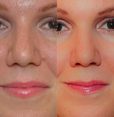 18-24 year old woman treated with Mole Removal - Cosmetic Mole Removal