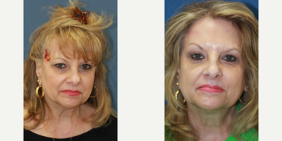 Mohs Surgery Reconstruction - Mohs Surgery Reconstruction