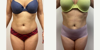 25-34 year old woman treated with Liposuction - Patient is 2 years after tumescent liposuction of the abdomen, hips, back and thighs