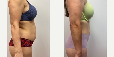25-34 year old woman treated with Liposuction - Patient is 2 years after tumescent liposuction of the abdomen, hips, back and thighs