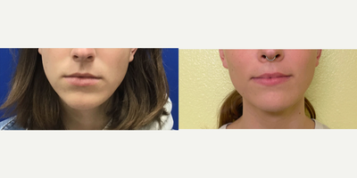 Patient treated with Genioplasty - Chin Contour and Reduction - 18 to 24 year-old female patient is 11 months post-op from Genioplasty/Chin Augmentation surgery. Her procedure was: Chin Contour and Reduction.