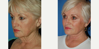 Woman treated with Cheek Implants - Woman treated with Cheek Implants