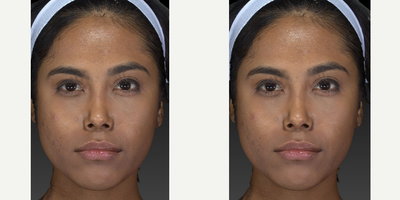 25-34 year old woman treated with Chin Surgery - This is a pretty young woman who came for chin, cheek and jawline sculpting for a softer and more elegant look. We did a combination of surgical approach to sculpt the jaw and chin, buccal fat removal and fillers. Looking good!DrC