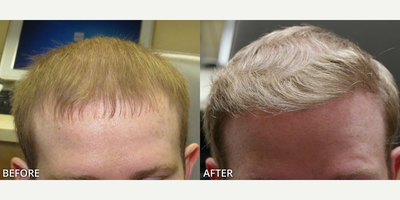 Man treated with ARTAS Robotic Hair Transplant, Hair Transplant - Man treated with ARTAS Robotic Hair Transplant, Hair Transplant
