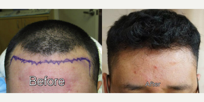 Man treated with ARTAS Robotic Hair Transplant, Hair Transplant - Man treated with ARTAS Robotic Hair Transplant, Hair Transplant