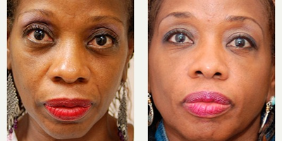 Woman treated with Perlane - Injectable Fillers