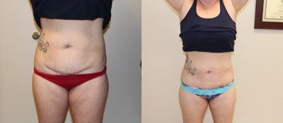 35-44 year old woman treated with Body-Jet - Pt underwent Bodyologie Body-Jet (minimally-invasive liposuction). After picture taken 32 days later.