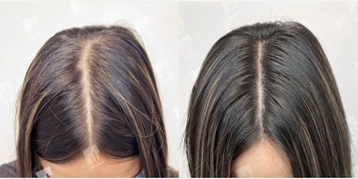 27 year old woman treated with Scalp Micropigmentation - 27 year old female who had Scalp Micropigmentation