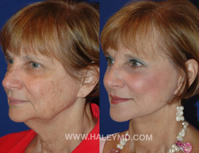 65-74 year old woman treated with Eyelid Surgery - Face and neck lift with upper and lower blepharoplasty under local anesthesia done in the office.