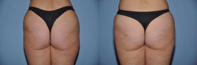 Brazilian Butt Lift - At 42 this person came to see me for improvement in the fullness of her buttocks and to remove some bulges of her hips and thighs. On exam, she was fit, at a great weight, but had some hollows and flattening of her buttocks on the sides. And she also had some excess fat of the hips and lateral thighs.We used VASER Liposuction to remove the fat, which I immediately used to enhance her buttocks. This so-called Brazilian Butt Lift is possible because the VASER Liposuction uses ultrasound energy to separate the fat from surrounding tissue. She had some soreness and swelling after surgery, but less than with old style liposuction.