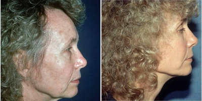 45-54 year old woman treated with Facelift - This patient decided on facelift surgery at our Sacramento practice with Dr. Yamahata to alleviate some of the visual signs of facial aging while preserving her own unique features. In her after photos, it's clear that her skin is smoother and her jawline, neck, and chin are sleeker and tighter.