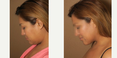 25-34 year old woman treated with Buccal Fat Removal - liposuction of the neck