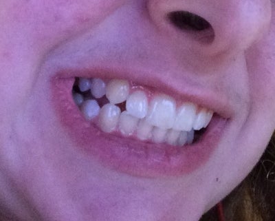 teeth shifted after braces