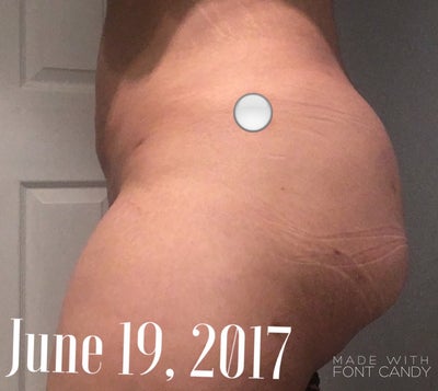 Botched Bbl Brazilian Butt Lift Gone Wrong Review Realself