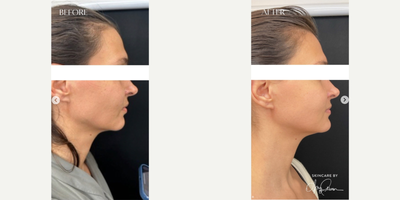 Woman treated with Renuva - Woman treated with Renuva