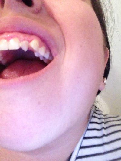 I have (what I believe is called) a slight snaggletooth and a gap. What ...