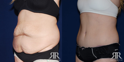 Tummy Tuck - Tummy Tuck