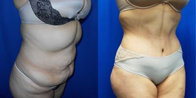 35-44 year old woman treated with Liposuction - The patient is a 35 year old female who has 3 children. She is seen 3 months after a tummy tuck with Vaser and Power-assisted liposuction of the upper abdomen. She had  900cc's of fat removed from the upper abdomen. The patient was 5 feet 2 inches tall and weighed 181 lbs. at the time of surgery. She weighed 169 lbs after surgery.