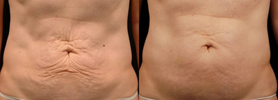 35-44 year old woman treated with Thermage - 3 months after Thermage abdomen