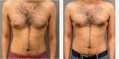 25-34 year old man treated with Gynecomastia Surgery - 28 year old male s/p gynecomastia liposuction with excision performed under local anesthesia with sedation in our on site AAAA certified operating suite.