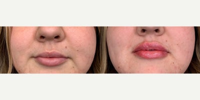 25-34 year old woman treated with Lip Augmentation - Before and After: Lip Augmentation using 1 syringe of Versa. Done by Cynthia, RN