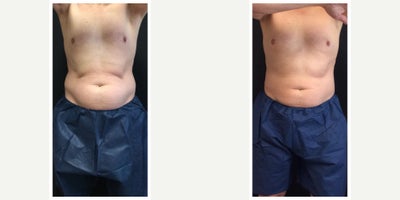 35-44 year old male treated with Venus Legacy - Venus Legacy and CoolSculpting