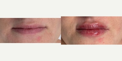 25-34 year old woman treated with Restylane - Lip fillers with Radhika, the Nurse Practitioner at Wise Med Spa