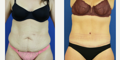 25-34 year old woman treated with Body Lift - Body lift after 180lbs of weight loss.
